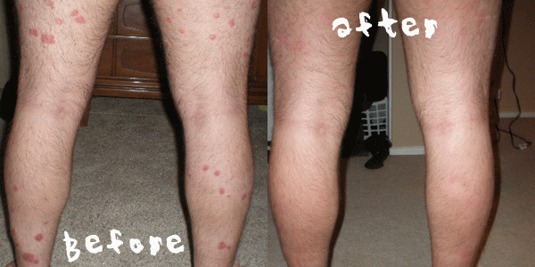 Stelara Before and After Photo